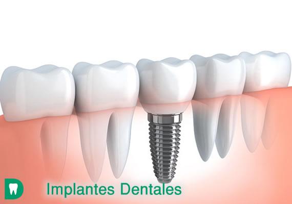 Un implante dental es un componente de titanio que se ubica por medio de una cirugía en el maxilar debajo de la encía, el cual permite al dentista incrustar el diente de reemplazo, los implantes no se sacan como las dentaduras.